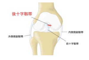 膝後十字靱帯損傷　膝PCL損傷