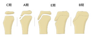 Cartilaginous stage　Apophyseal stage　Epiphyseal stage　Bony stage　オスグット　成長段階
