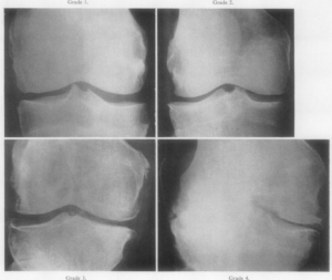 変形性膝関節症　膝OA　レントゲン　分類　Kellgren-Lawrence　KL　分類