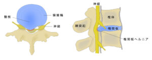 腰椎椎間板ヘルニア　腰椎　脊髄　イラスト
