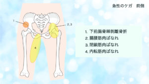 下前腸骨棘剥離骨折　腸腰筋肉ばなれ　内転筋肉ばなれ　閉鎖筋肉ばなれ　股関節の痛み　前面