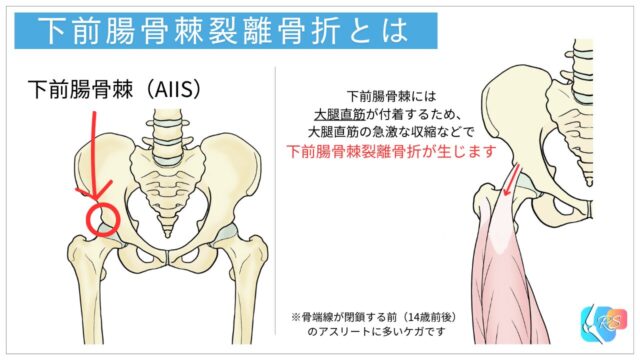 下前腸骨棘裂離骨折　剥離骨折　AIIS