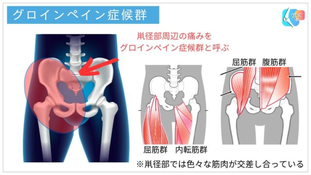 グロインペイン　グロインペイン症候群