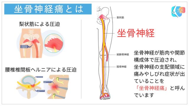 坐骨神経　坐骨神経痛　梨状筋　腰椎椎間板ヘルニア
