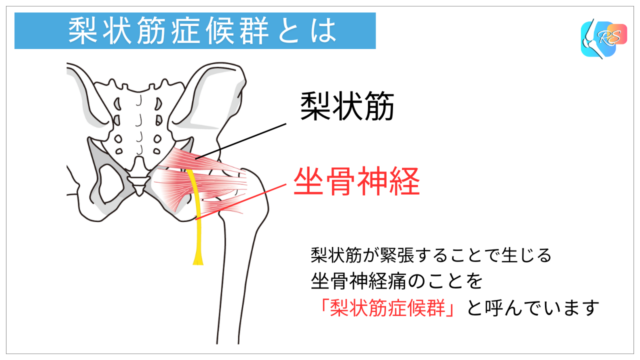 梨状筋　坐骨神経　梨状筋症候群